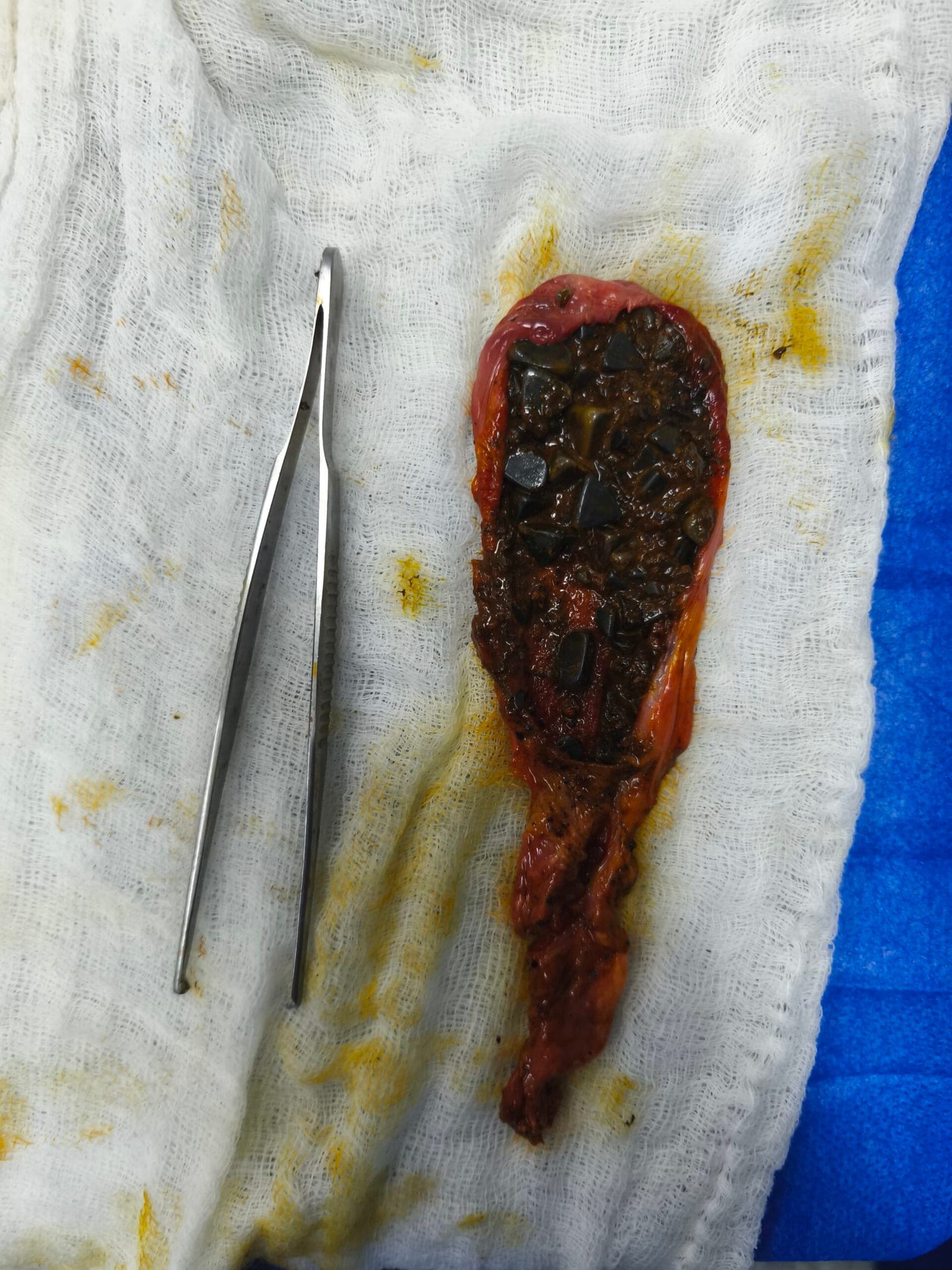 Vesícula con múltiples cálculos en su interior complicada por cuadro de colecistitis aguda. Operada por el Dr. José Miguel González, cirujano general especialista en laparoscopia avanzada en Valencia y Caracas.
