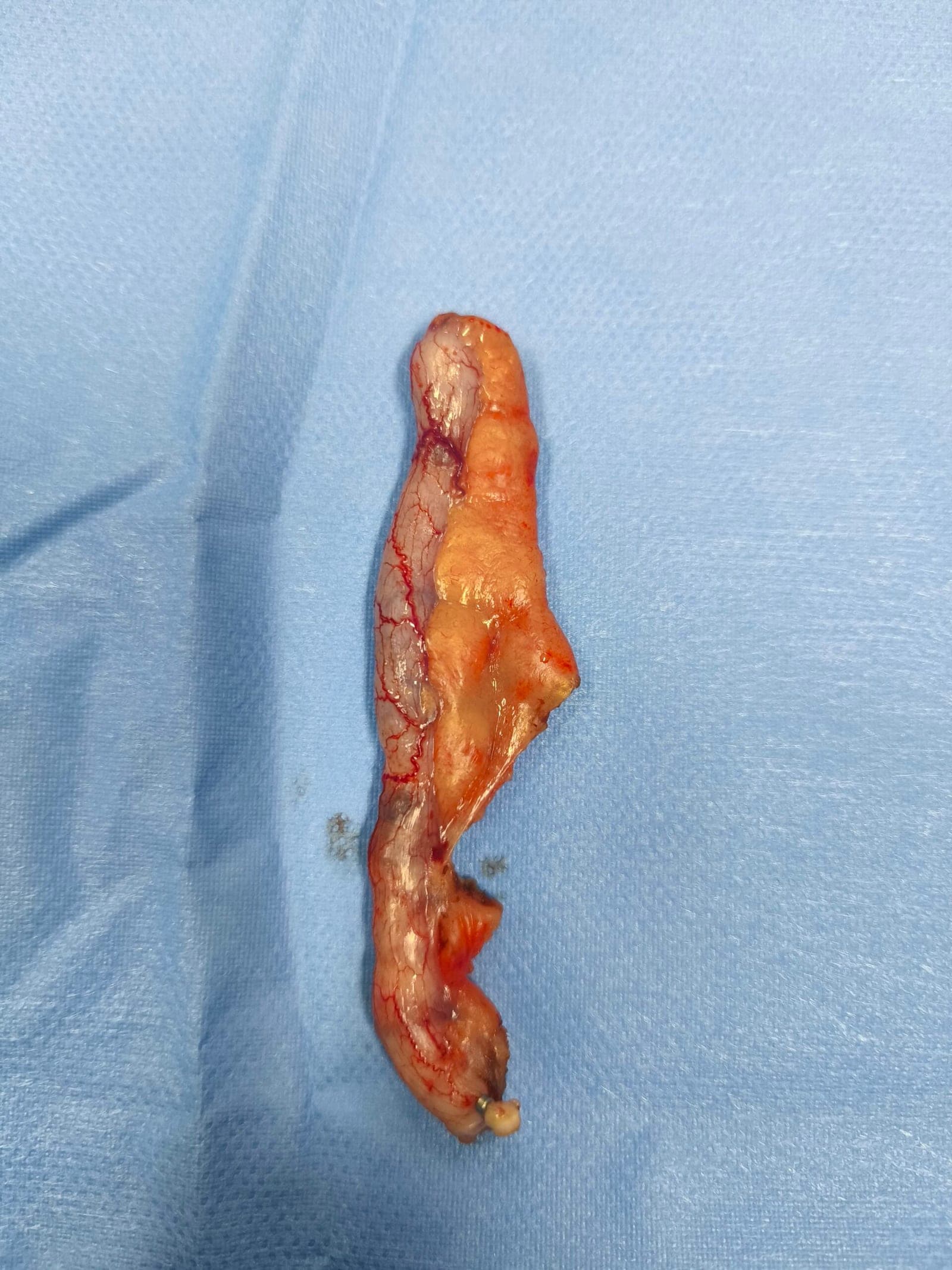 Apéndice en fase catarral operada por vía laparoscópica por apendicitis aguda. Operada por el Dr. José Miguel González, cirujano general especialista en laparoscopia avanzada.